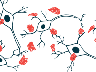 Amyloid plaques are shown forming on nerve cells.