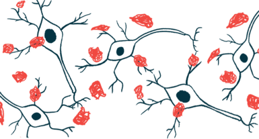 Amyloid plaques are shown forming on nerve cells.