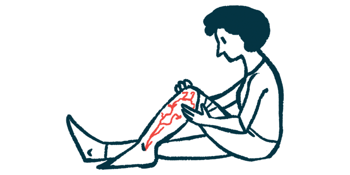 A woman rolls up a pants leg to reveal damaged nerves in her leg.